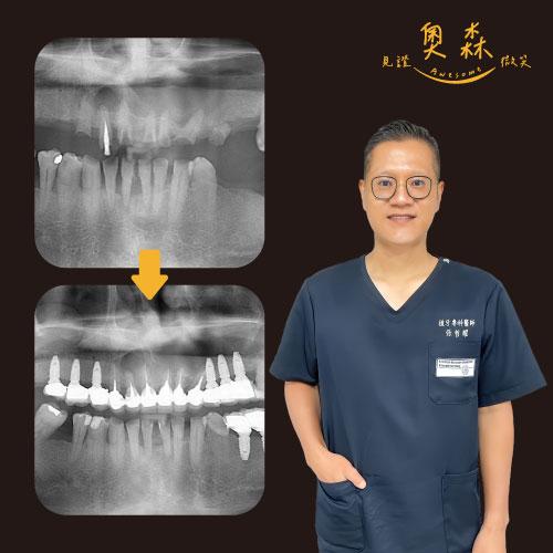 全口重建 X 過多缺牙的補救英雄 │ 張哲耀醫師