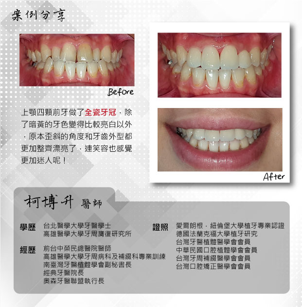 全瓷牙冠 X 門面前齒的修飾 │ 柯博升醫師