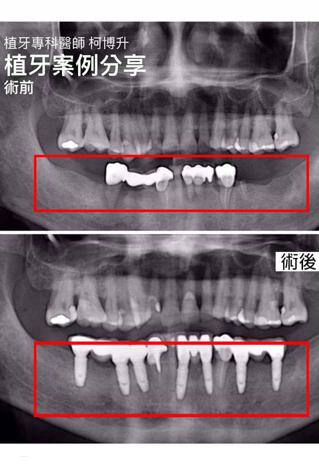 人工植牙 X 長期缺牙的填補 │ 柯博升醫師
